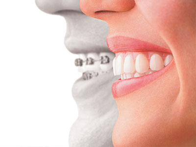 The image shows a split-screen comparison between a smiling person s teeth and a dental implant, with the text  DENTAL IMPLANT  prominently displayed.