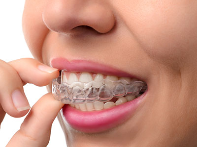 The image shows a person wearing a clear braces appliance with their teeth visible, holding their hand up to their mouth.