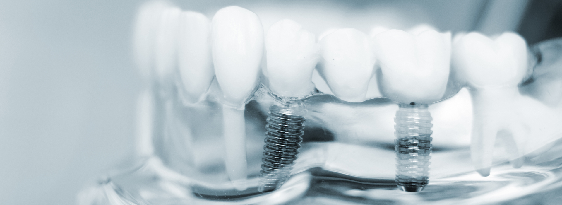 The image shows a close-up view of a dental implant with screws, taken from an overhead angle, against a blurred background.