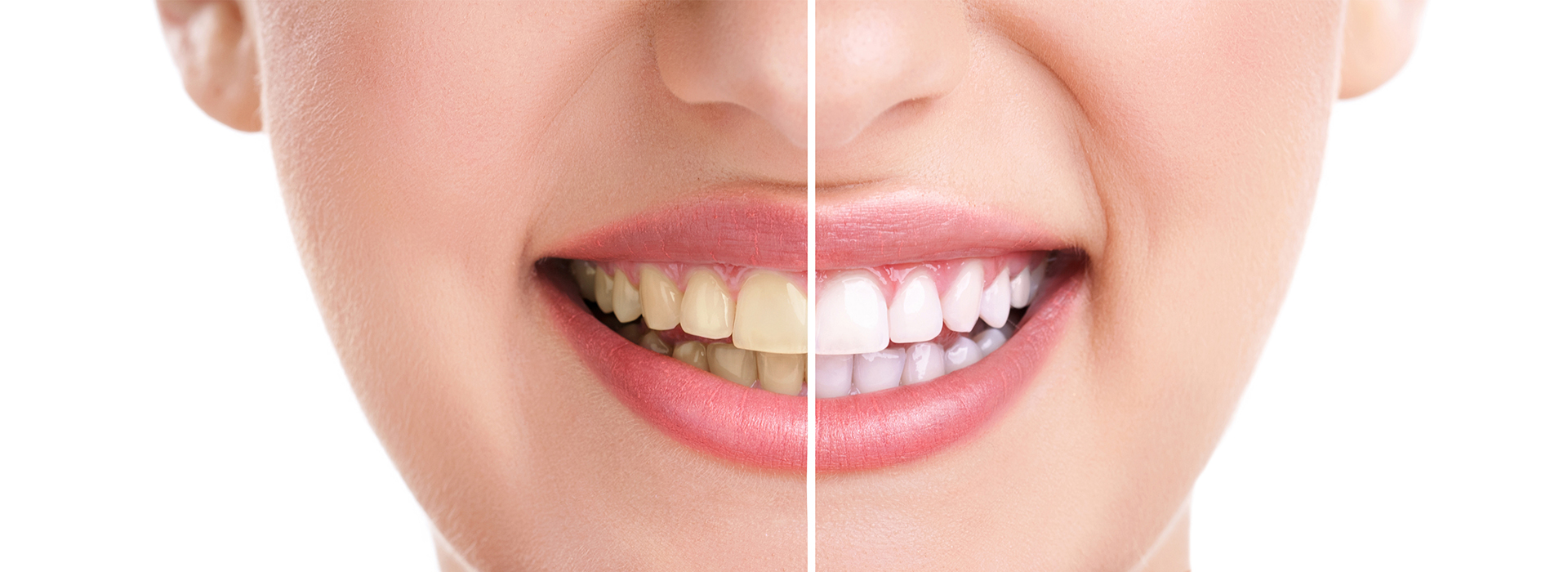The image shows a close-up of a woman s face with a smile, featuring teeth whitening strips on her upper teeth.