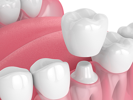 The image features a close-up view of multiple teeth with varying shades of pink and white, arranged in rows, against a white background.