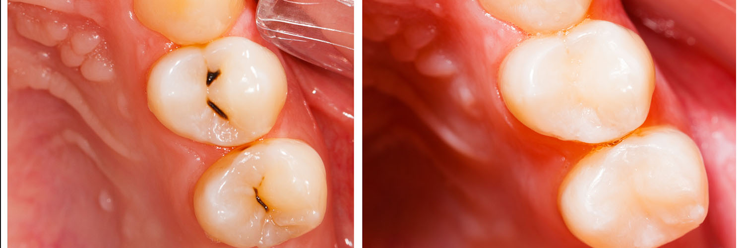 The image shows a close-up view of a human mouth with teeth, featuring two prominent front teeth with cavities, one on each side, against a dark background.