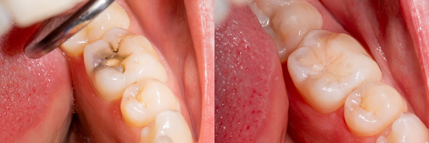 The image shows a close-up view of a mouth with multiple teeth undergoing dental treatment, with visible signs of decay and tooth removal, emphasizing oral hygiene issues.