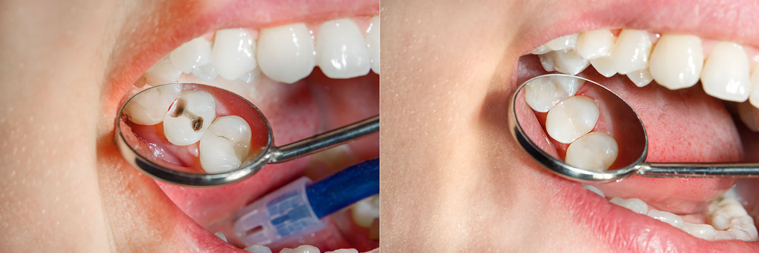 The image shows two photos side by side on the left, a close-up of a person s mouth with a toothbrush inside, and on the right, an open mouth with a dental mirror reflecting the person s teeth and tongue.