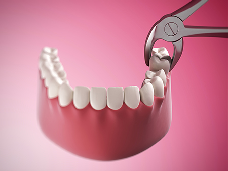 A close-up photograph of a dental implant being placed into a tooth socket using a precision drill.
