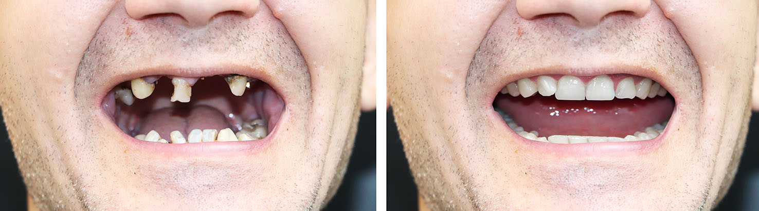 The image shows a person s face with a missing tooth, captured from two different angles, set against a gray background.