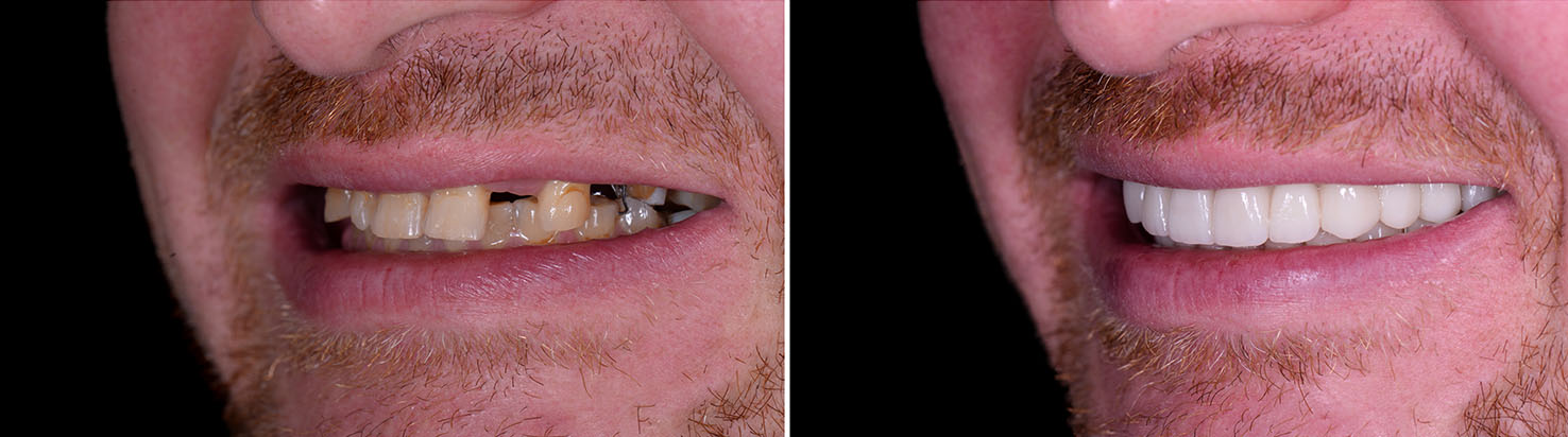 The image shows a person with two different smiles, showcasing their dental work, with an  alt  tag that reads   A before-and-after comparison of teeth whitening results.